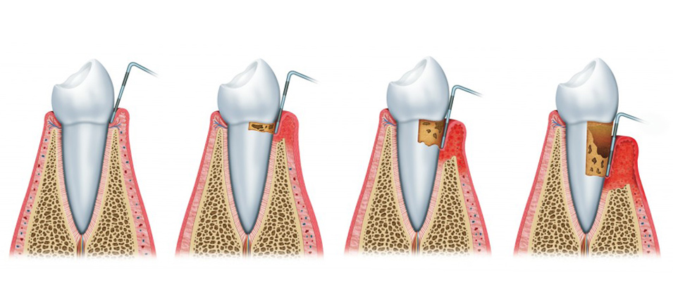 Enfermedades periodontales