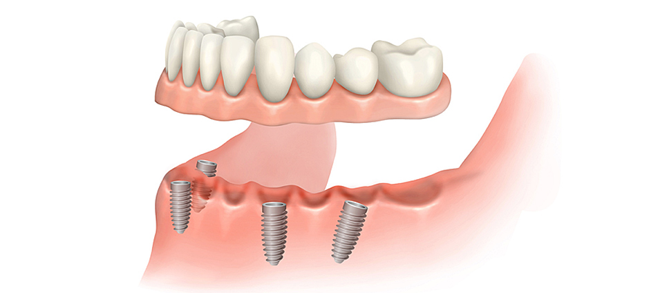 protesis-dental-fija-6
