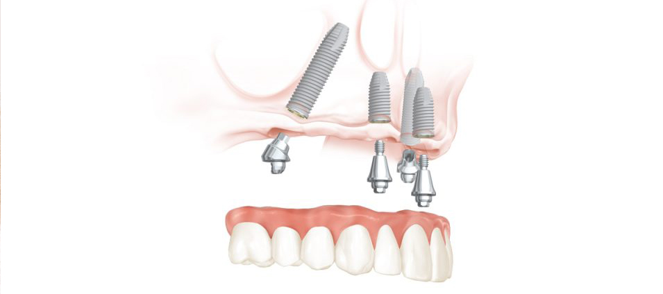 protesis-dental-fija-7