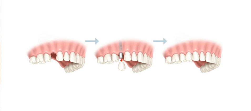 protesis-dental-fija-8