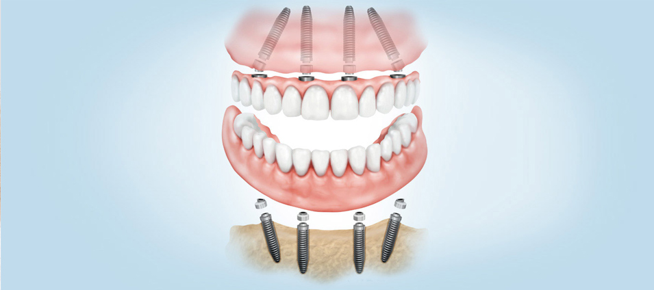 protesis-dental-fija-9