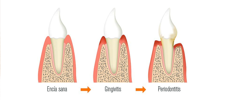 ¿Cómo se curan las enfermedades periodontales? • BQDC